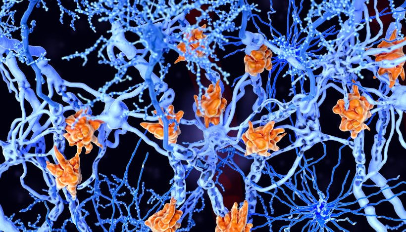 Multiple sclerosis (MS): microglia cells damage the myelin sheath of neuron...