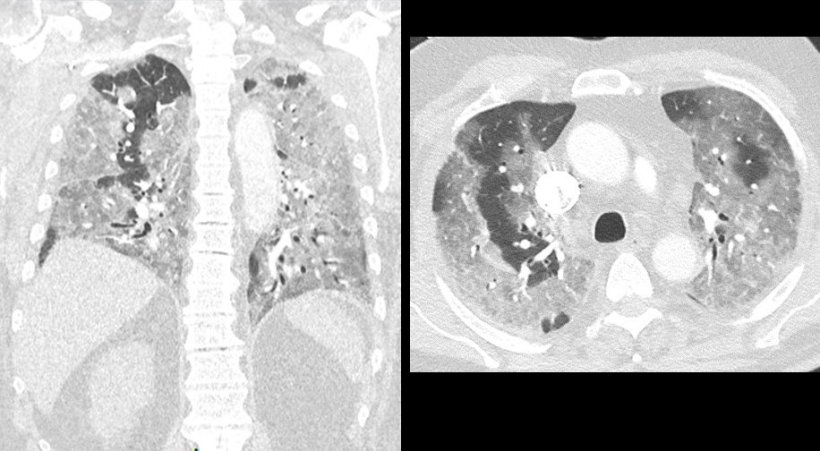Illustration of CT detected lung lesions in Covid-19 infection. These images...