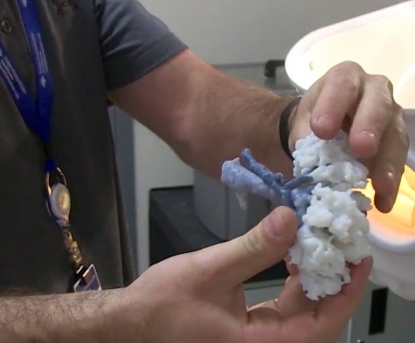 3D model of patients kidney that was printed to help save the organ during...