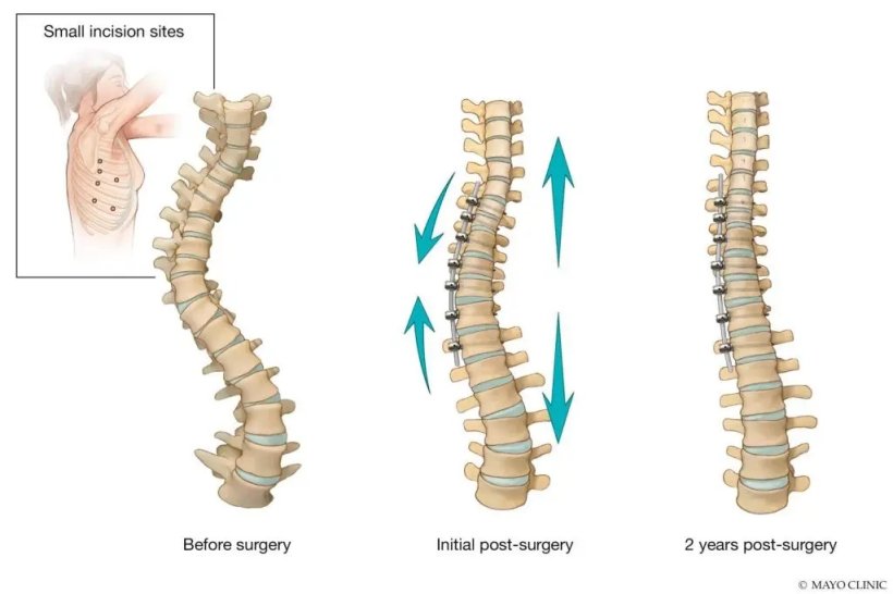 Treating scoliosis with vertebral body tethering