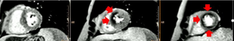 MRI/CMR assessment of viability/ischaemia in 70 year old male with suspected CAD