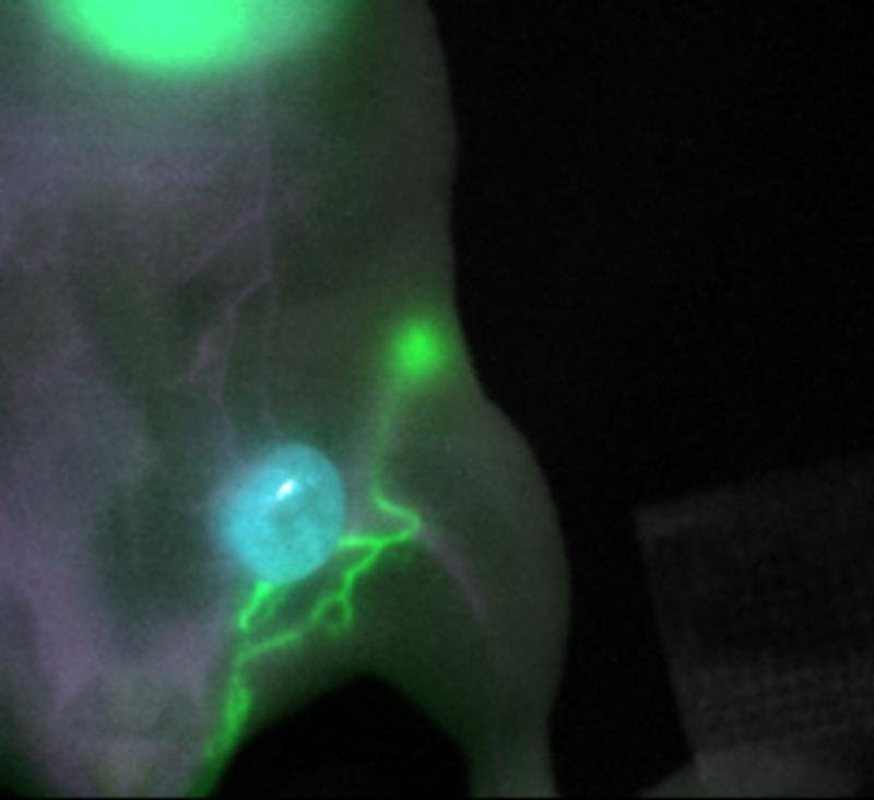 Die innovative Fluoreszenbildgebung macht Tumor (blau), Lymphgefäße (grün)...