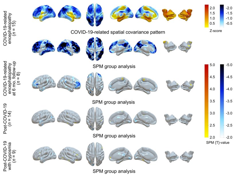 18F-FDG PET in Covid-19–related CNS disorders: Principal components analysis...