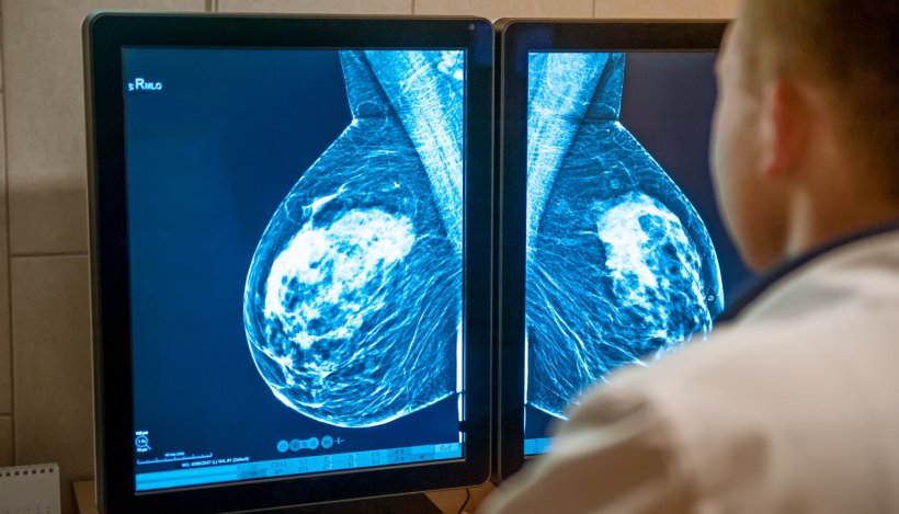 Doctor examines mammogram of breast on monitors