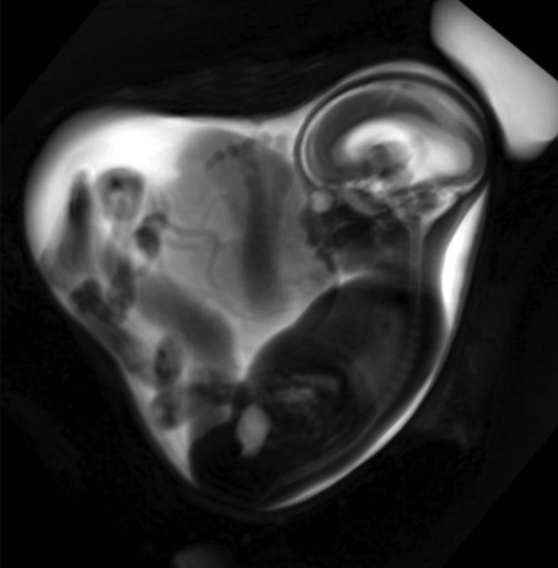 Die fetale MRT ist eine spezialisierte Bildgebungsmethode der pränatalen...