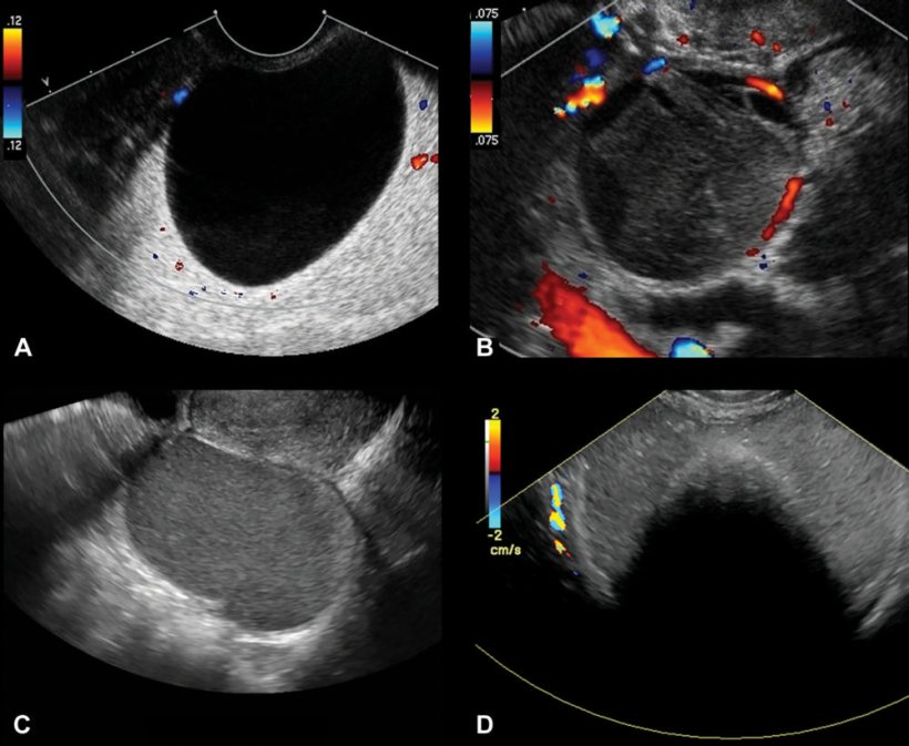 Using Ultrasound To Predict Ovarian Cancer • Healthcare In