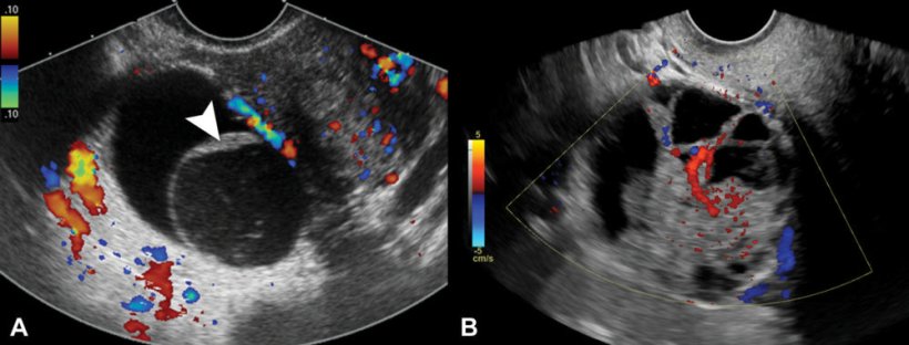 Representative transvaginal US images of nonclassic lesions; color Doppler...