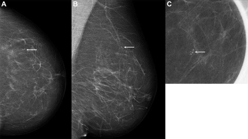 Images in a 60-year-old woman with an invasive screen-detected cancer with an...