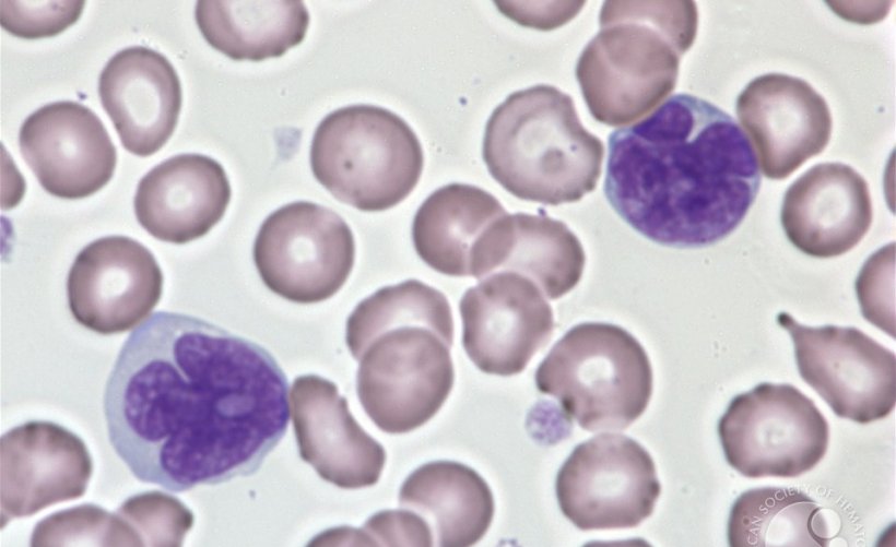 Adult T-cell leukemia/lymphoma (ATLL). The leukemia cells have irregular nuclei...