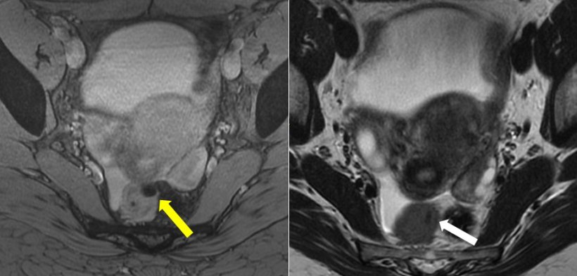 An ovoidal signal void (yellow arrow) on T2*-weighted imaging (left image)...