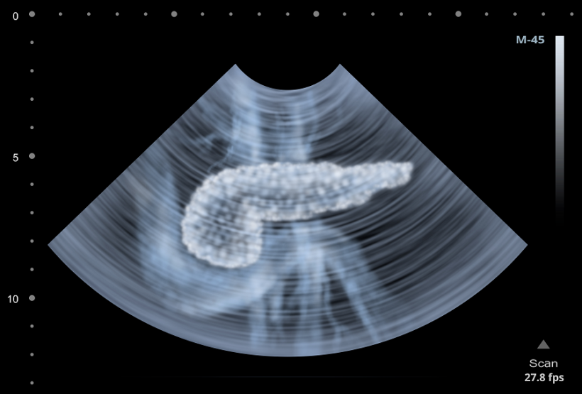 Illustration einer Ultraschalluntersuchung der menschlichen Bauchspeicheldrüse.