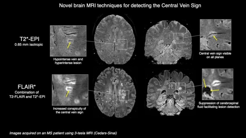 Images show novel brain MRI techniques for detecting the Central Vein Sign.