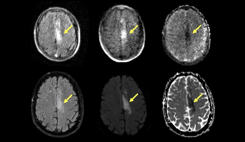 Portable MRI (top row) can detect and characterize ischemic stroke identified...