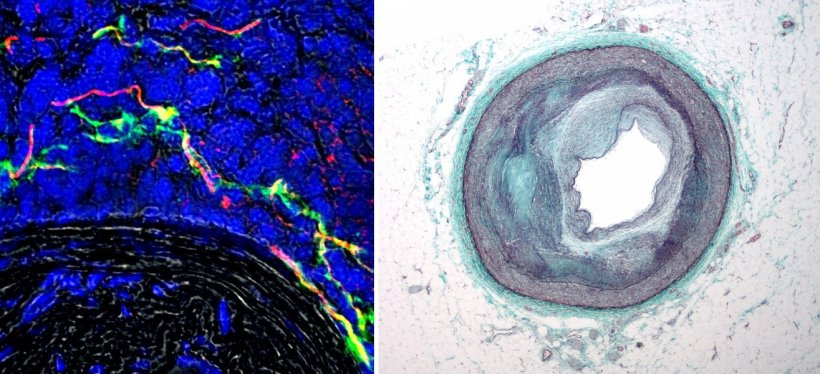 Left: Nerve bundles in the diseased artery external layer (adventitia)...
