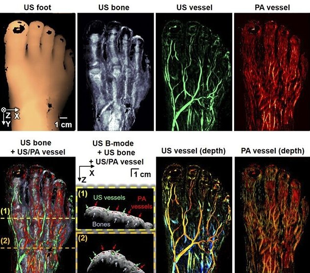 New 3D imaging technique to diagnose peripheral vascular diseases