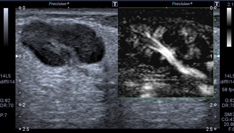 Fig. 1: Small reactive lymph node on the neck with normal vascular structure...