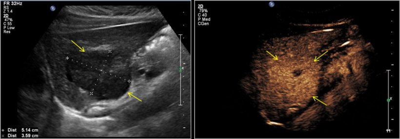 Fig. 3: Solid mass in the right lobe of the liver in a young female patient on...