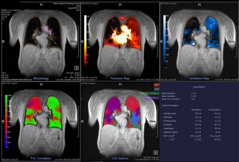 Imaging of different lung funcionalities using the PREFUL technique
