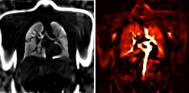 Ventilation (left) and perfusion (right) displayed in PREFUL