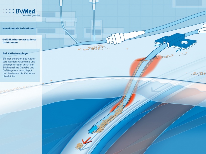 To prevent intravascular catheter-related infections further, the new...