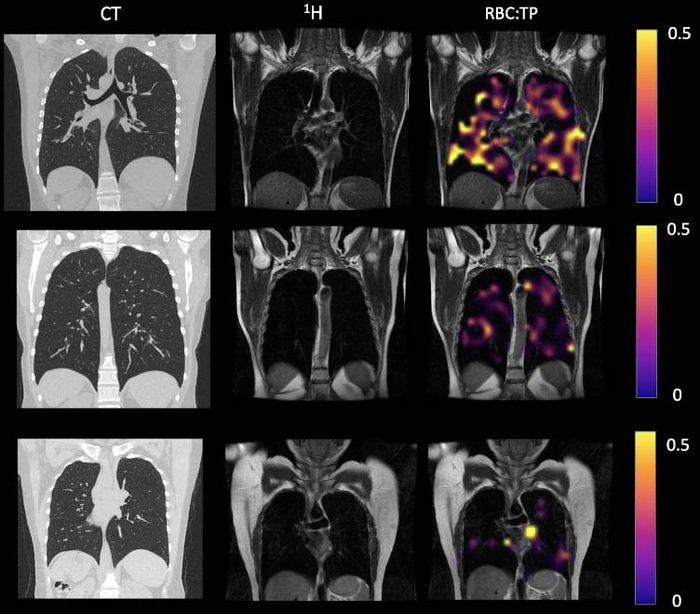 Example CT, proton, proton and RBC:TP imaging from post-Covid-19 condition...