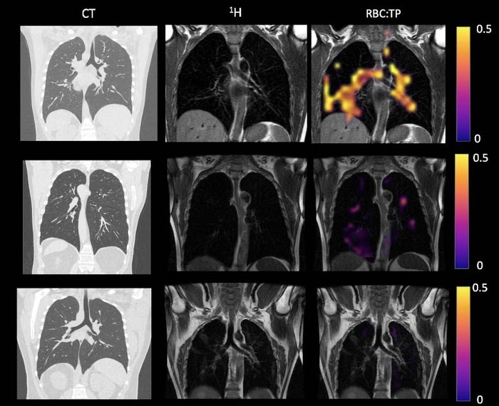 Example CT, proton, proton and RBC:TP imaging from post-hospitalized...