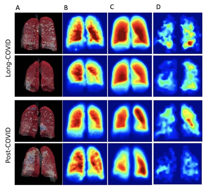 3D render of full-scale airway network modelling analysis (FAN) (A), FAN...