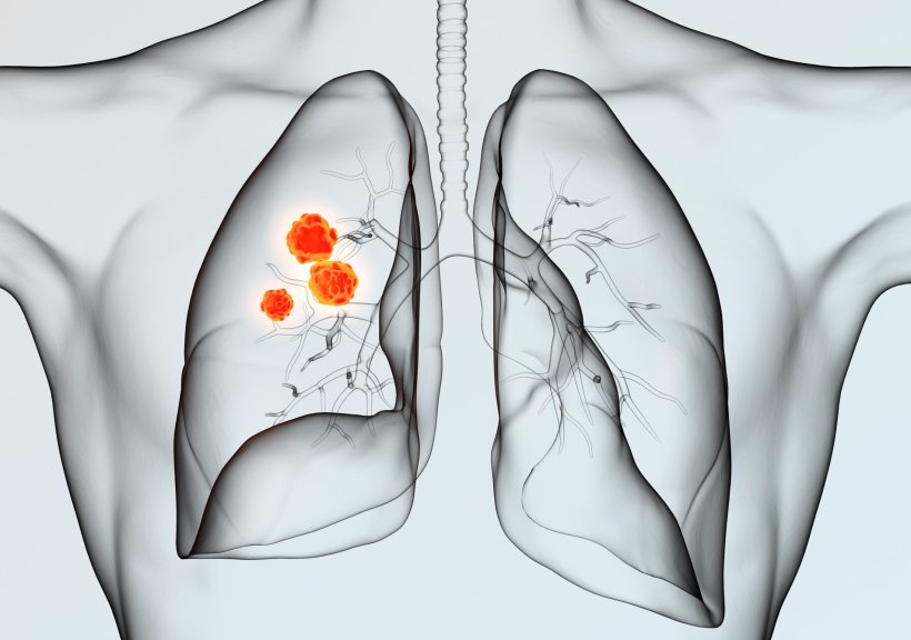 lung cancer 3d illustration