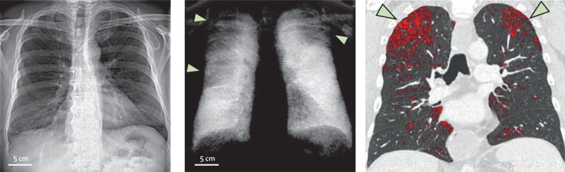 Left: Chest X-rays of male patient, aged 58: In the dark-field image (centre),...