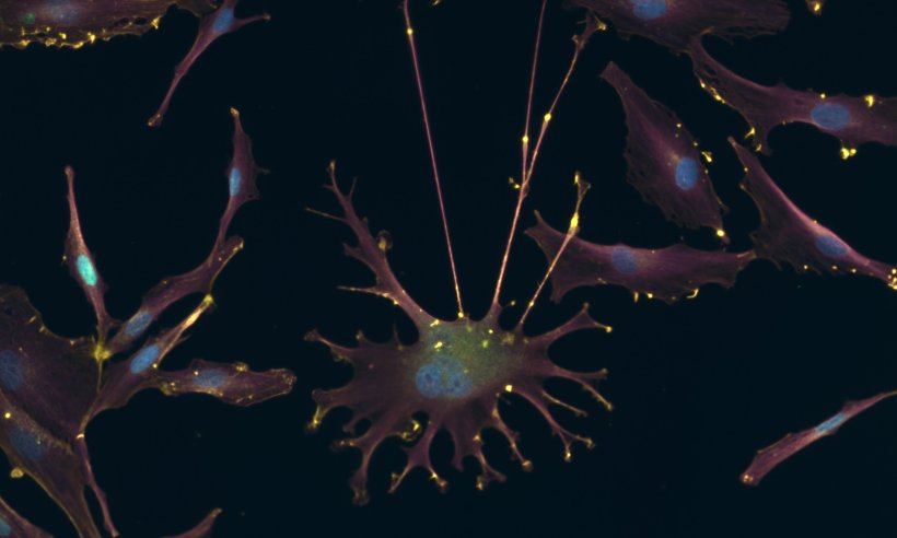 Melanomzellen, gefärbt für Zellstrukturen und Zellteilungsmarker