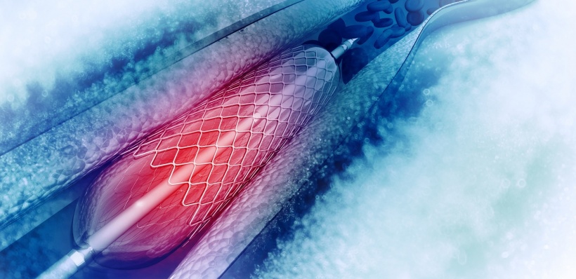 Stent angioplasty procedure with placing a balloon