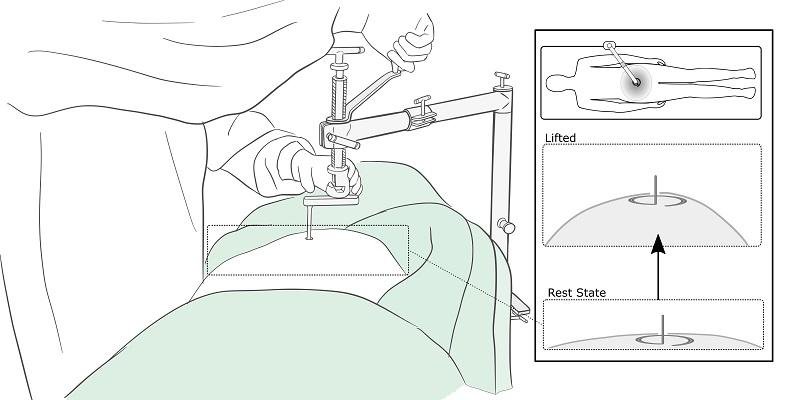 A diagram showing how the RAIS retractor is used to lift the abdominal wall...