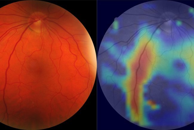 Left: Image of the retina. Right: Output of our AI model, which shows the...