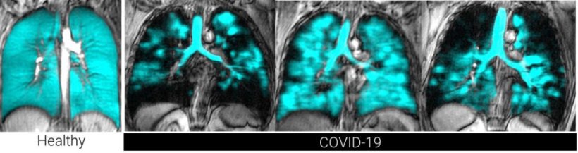 Imaging of the lung