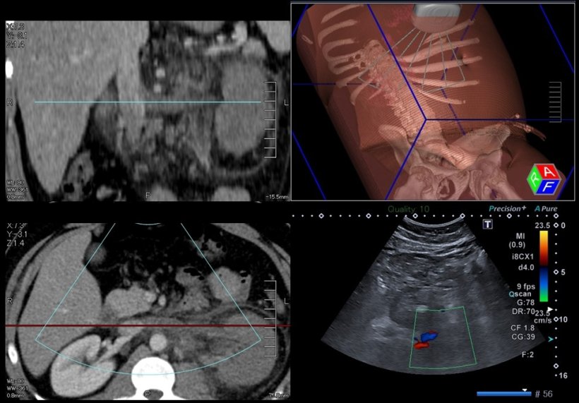 Example of cooperation with nephrology: CT/US image fusion in renal vein...