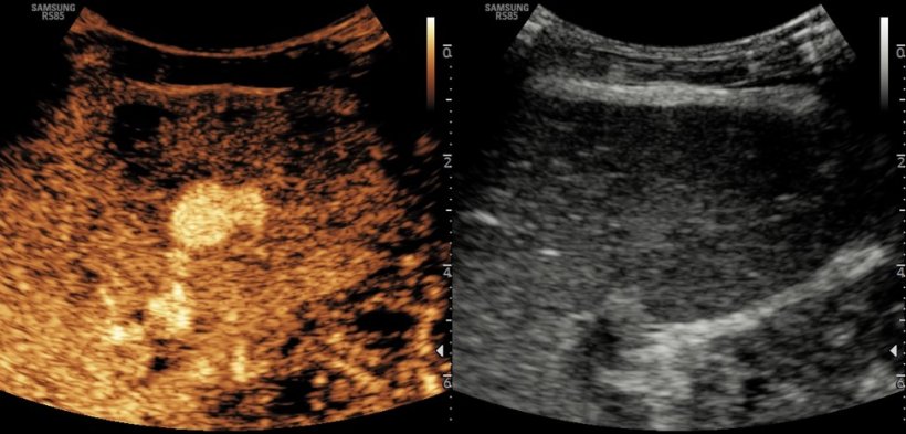 Splenic pseudo-aneurysm following trauma with CEUS