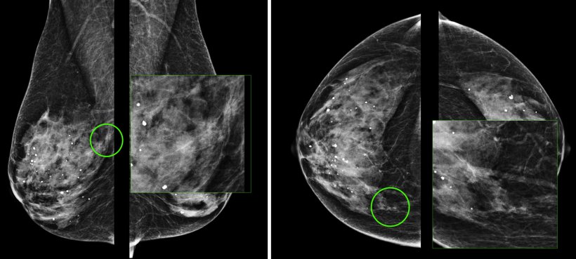 55 years old woman: palpable mass on the right breast, core biopsy under US...