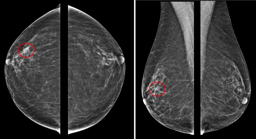 63 years old woman: right breast : retroareolar small hypoechoic nodule, core...