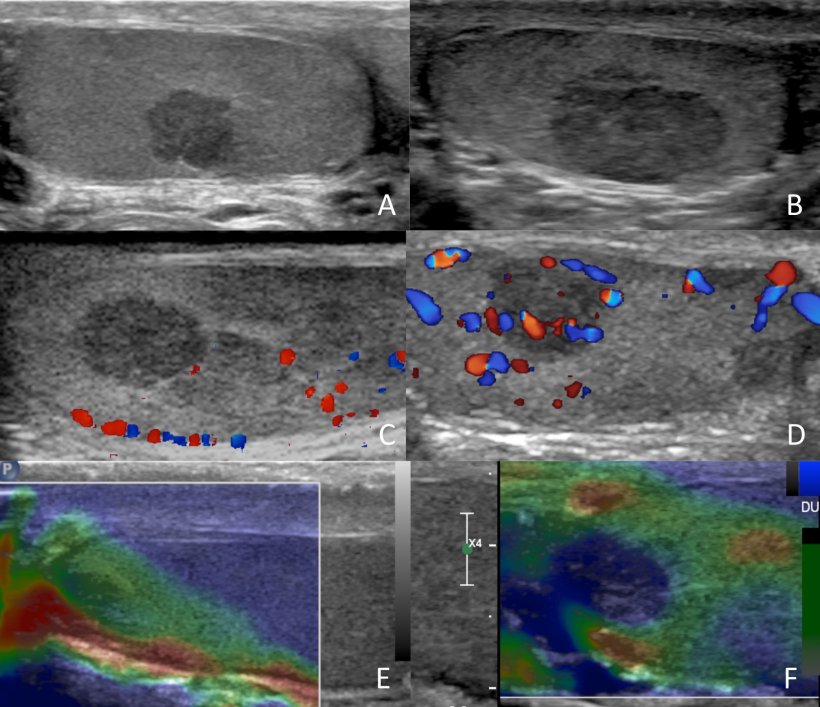 Utility of B-Mode, Color Doppler and Elastography in the Diagnosis