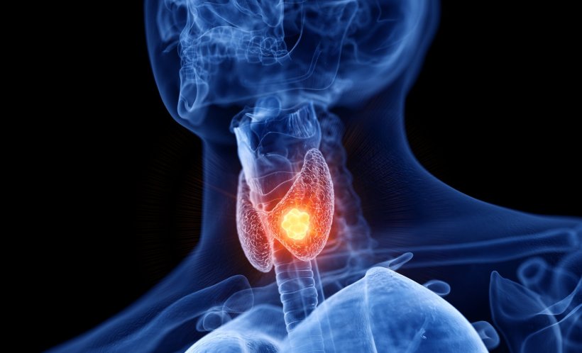 3d rendered medically accurate illustration of thyroid cancer