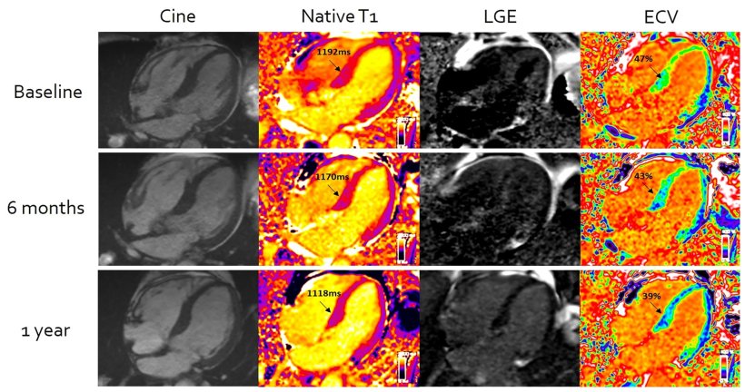 Cardiac systemic light-chain amyloid regression on serial cardiovascular...