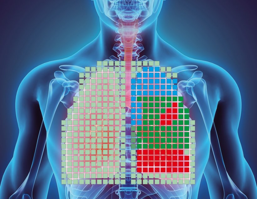Die visuelle Darstellung zeigt die unterschiedlichen Bereiche der Lunge und...