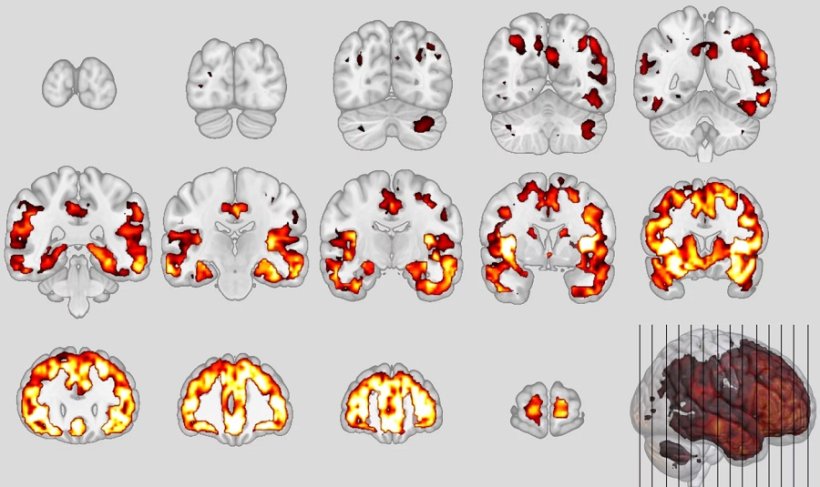 Neuroanatomical patterns of the behavioral variant of frontotemporal dementia.
