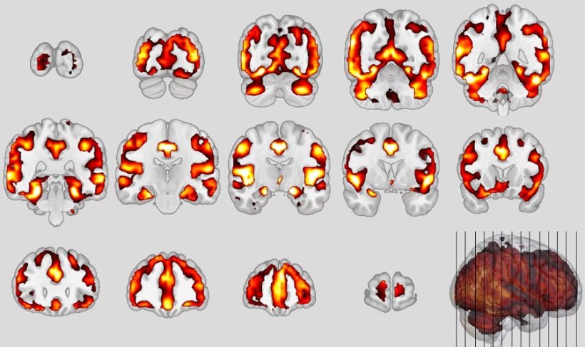 Neuroanatomical patterns of schizophrenia.