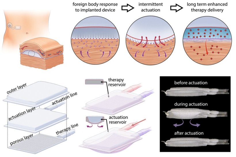 The drug-delivery system includes an actuator that repeatedly inflates and...