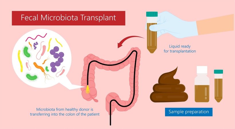 Fäkale Mikrobiota-Transplantation (FMT) Stuhlübertragung von Bakterienmikroben