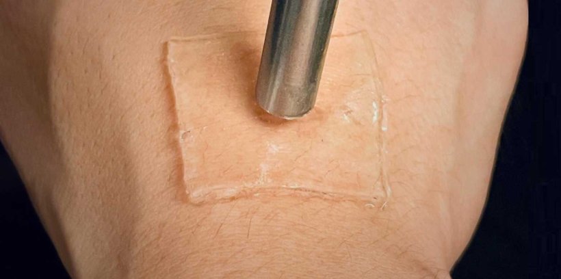 Mit Ultraschall lässt sich das Gelpflaster stark auf der Haut verankern