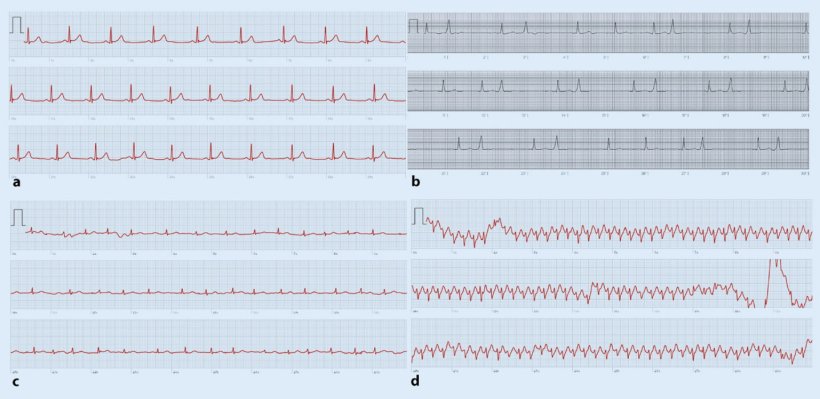 ecg curves