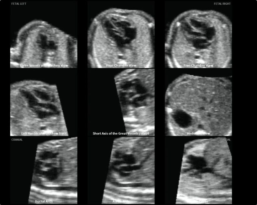 Nine examination planes are extracted from a volume data set of a foetal heart...