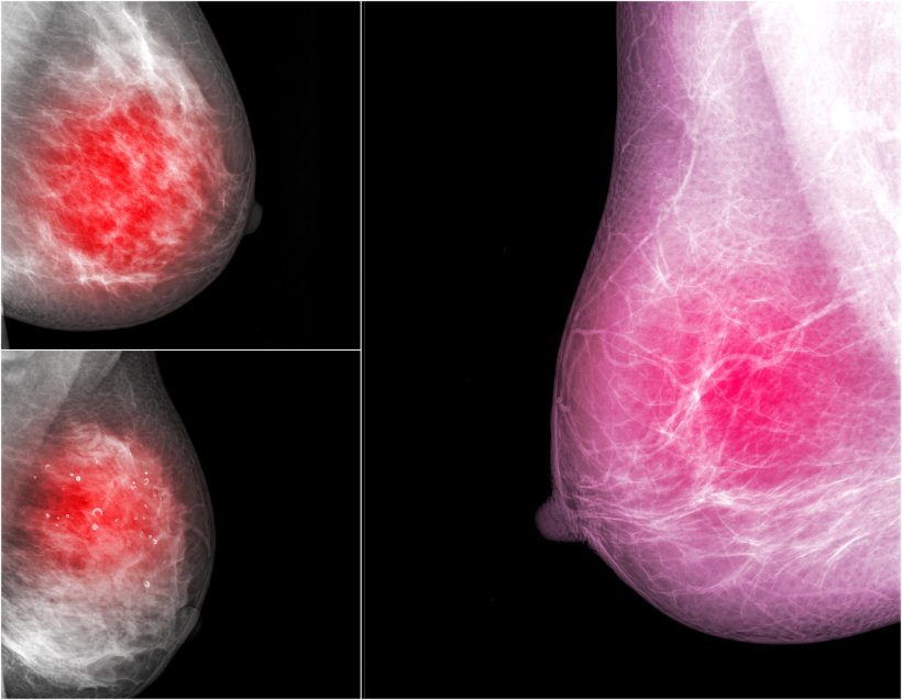 mammograms for breast cancer detection